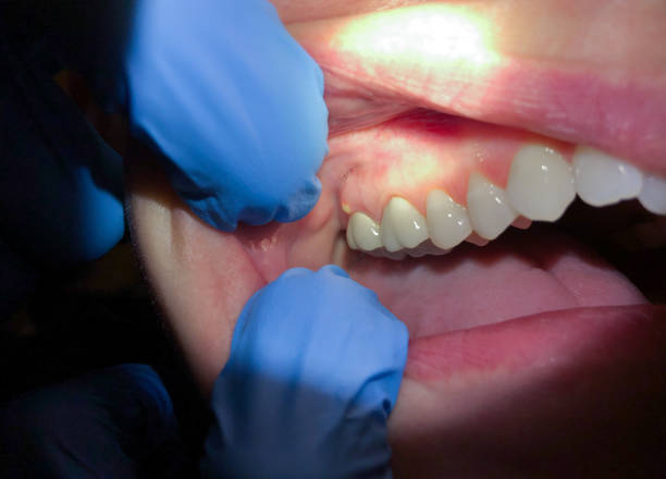 Best Dental Abscess Treatment in Nes, IL